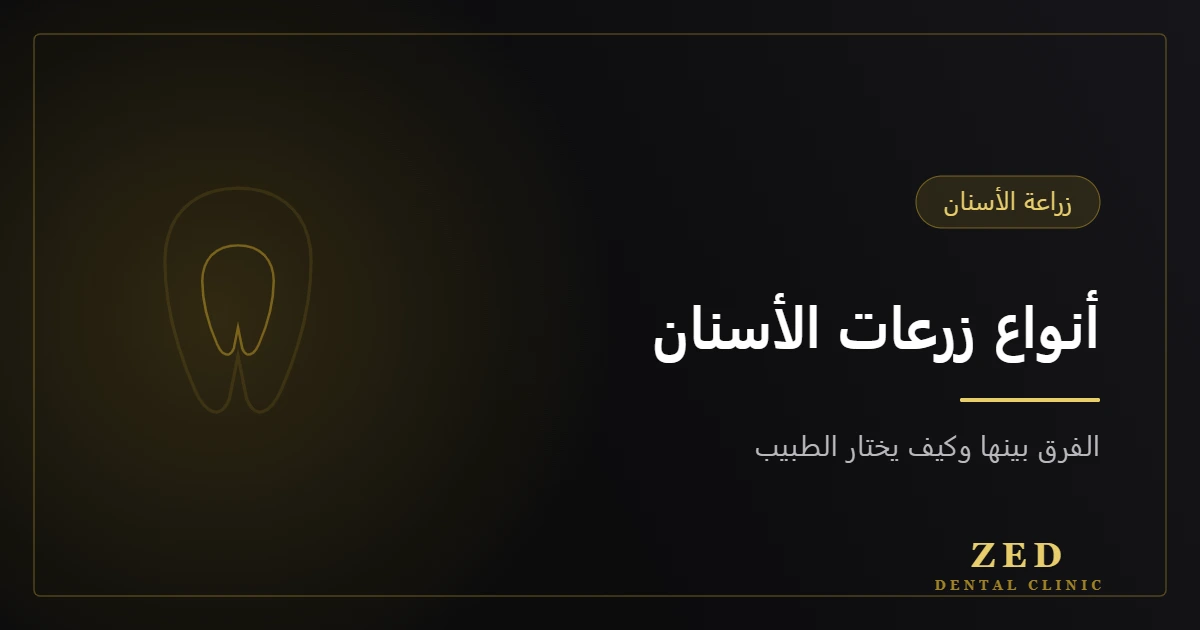 غلاف مقال أنواع زرعات الأسنان من مركز زد للأسنان