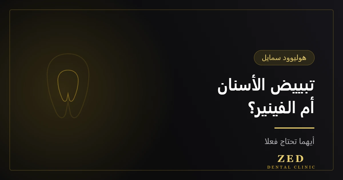 غلاف مقال تبييض الأسنان أم الفينير؟ من مركز زد للأسنان