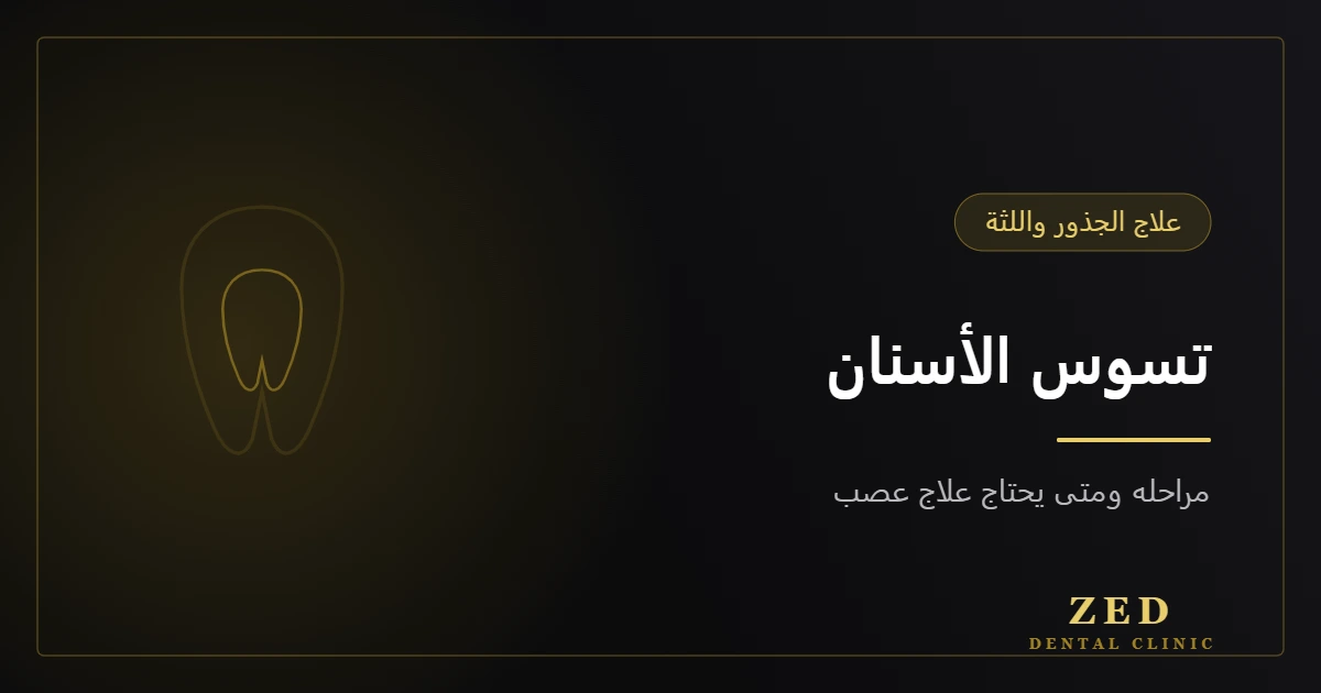 غلاف مقال تسوس الأسنان ومراحله من مركز زد للأسنان